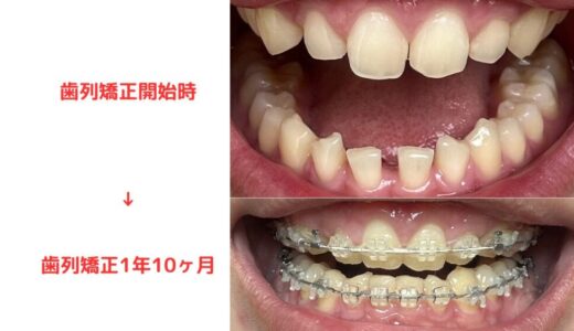 【はじめての方へ】このブログについて｜歯列矯正に悩むあなたへ